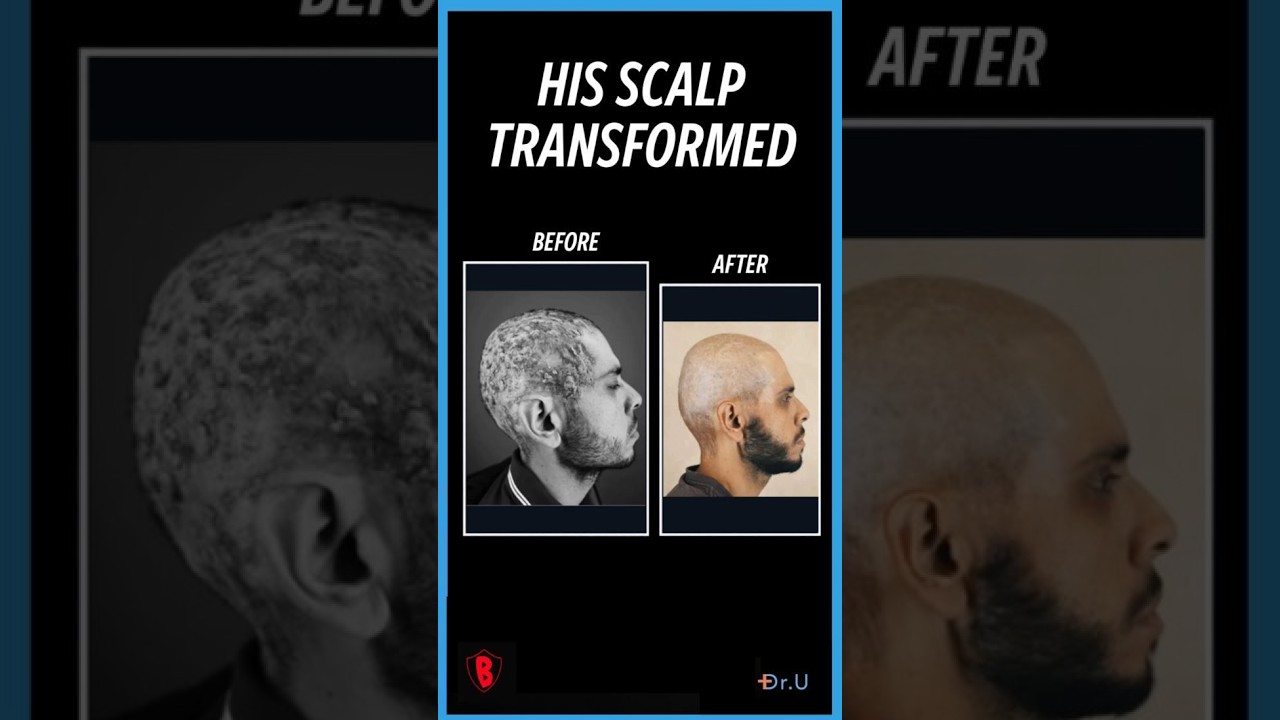 Painful Scalp Lumps Kept His Helmet Off. Look at Him Now