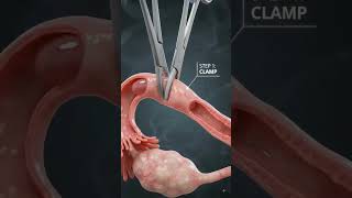 🤱 Tubectomy Explained in3D | 😱Permanent Birth Control #3D #viral #shorts