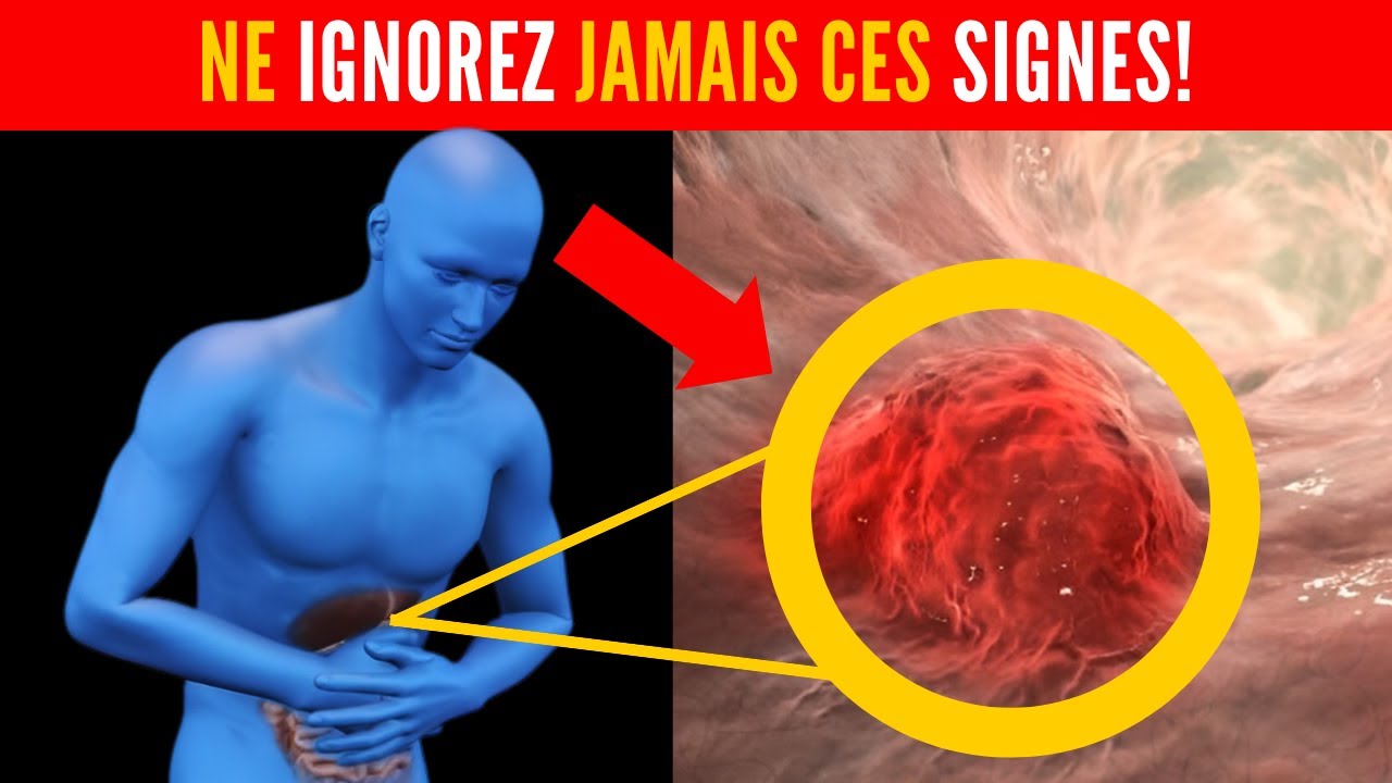 7 SYMPTÔMES d'ALERTE du CANCER DE L'ESTOMAC SIGNES SILENCIEUX que — free download