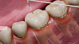 Exploring Stages of Gum Disease in Your Back Teeth