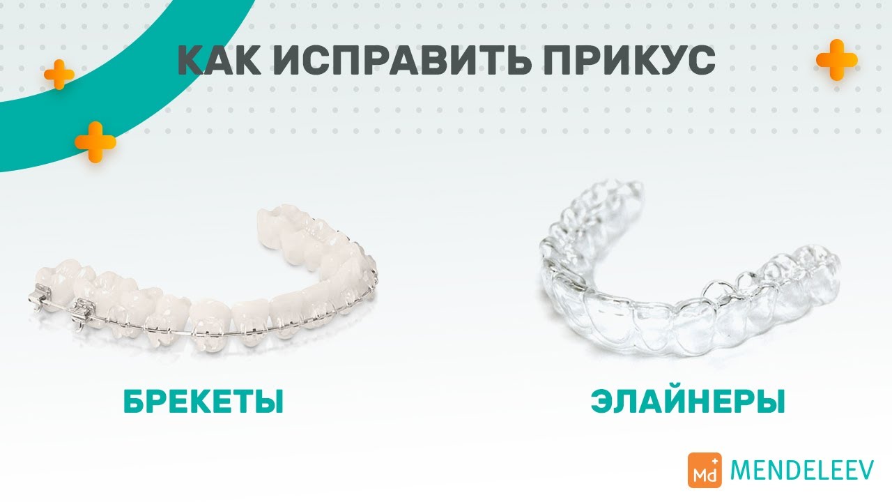 Как исправить прикус? Брекеты, элайнеры I Стоматология «Менделеев»