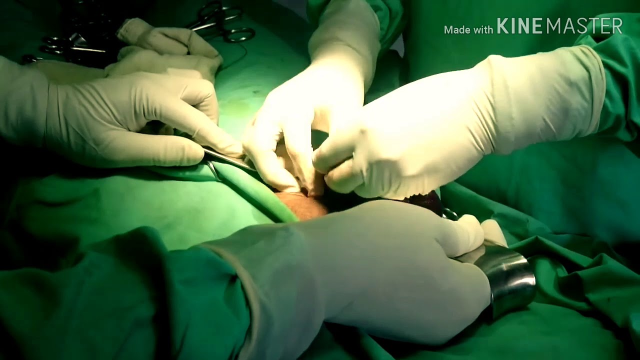 Removal of an Appendix (Appendectomy) YouTube