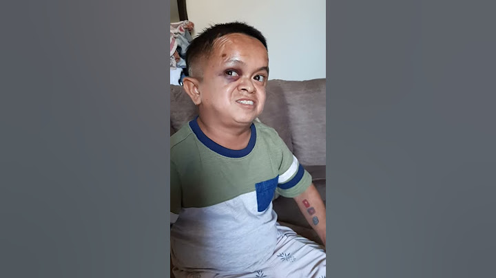 Jorgito el guayaco tiene el ojo emplomado