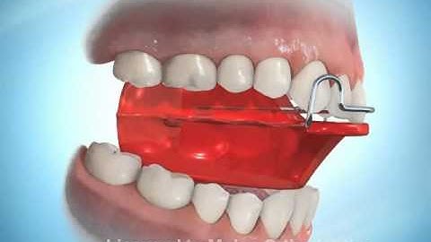 Ortodoncia Maxilar Bionator.wmv