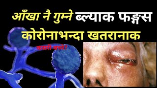 ब्ल्याक फंगस भनेको के हो? What is Black Fungus aka Mucormycosis?