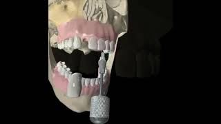 Implant Animation