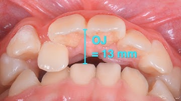 Excessive overjet with invisalign｜【Chris Chang Ortho】CC666