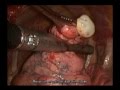 Pneumothorax  vats 2 port bullectomy and pleural abrasion