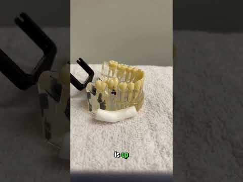 Hybenx application in  furcation area