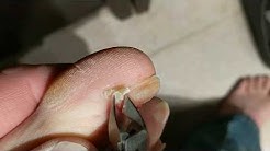 Watch me rip out my toenails!