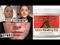AZTEC HEALING CLAY MASK EXPERIMENT ON ACNE PRONE SKIN | GET RID OF ACNE FAST | MOST POWERFUL MASK
