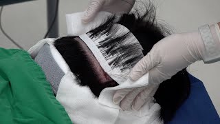 높은 생착률! 비절개 모발이식을 하는 과정. 숙련된 한국의 탈모 치료사