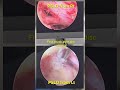 Full Endoscopic Spine Surgery #psld #endoscopicspinesurgery