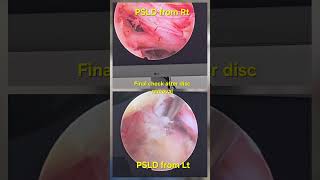 Full Endoscopic Spine Surgery #psld #endoscopicspinesurgery