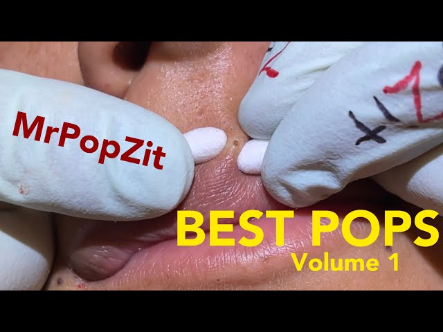 Top Pops volume 1. All kinds of pops from MrPopZit. Some new, some old. class=