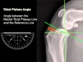 Measuring Tibial Plateau Angle