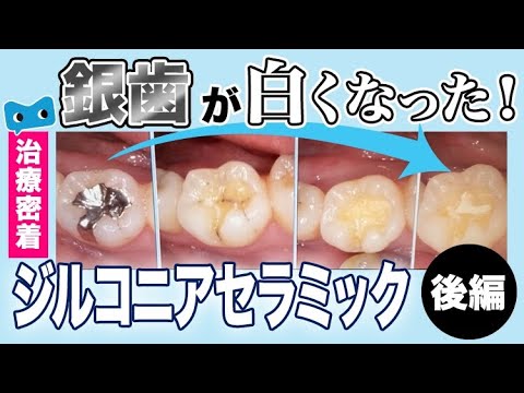さ*さ様 銀歯 セラミック】続編！銀歯→白いセラミックへ！治療密着