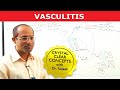 Vasculitis - Causes, Symptoms & Treatment