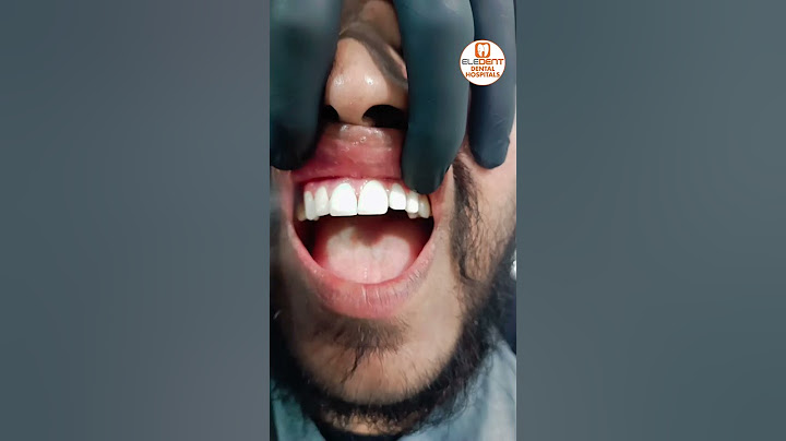 Fixing zirconia Teeth On Live At @EledentDentalHospitals | Best Dental Hospital In India | #shorts