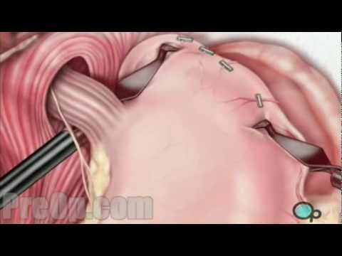 Anti-Reflux Laparoscopy Heartburn Surgery Medical PreOp® Patient Education