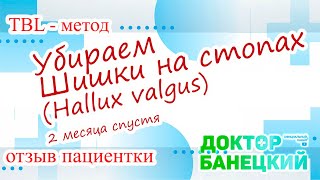 Отзыв после удаления Hallux valgus (шишки на стопах) 2 месяца после малоинвазивной операции