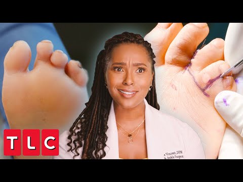 Dr. Ebonie Separates the Most Webbed Toes She