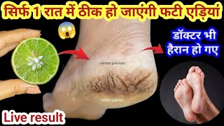 गारंटी है! 1 ही रात में ठीक हो जाएंगी फटी एड़ियां, ये जादुई उपाय एड़ी सॉफ्ट-मुलायम करेगा Cracked Heels screenshot 1
