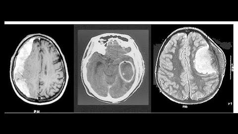 Part 1 EMS - Stroke Mimics and Chameleons