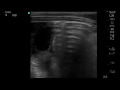 The Gut Point of Pneumoperitoneum