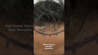 High Density Hair Transplant Microsurg #hairtransplant #fuehairtransplant #hyderabad #viralpost