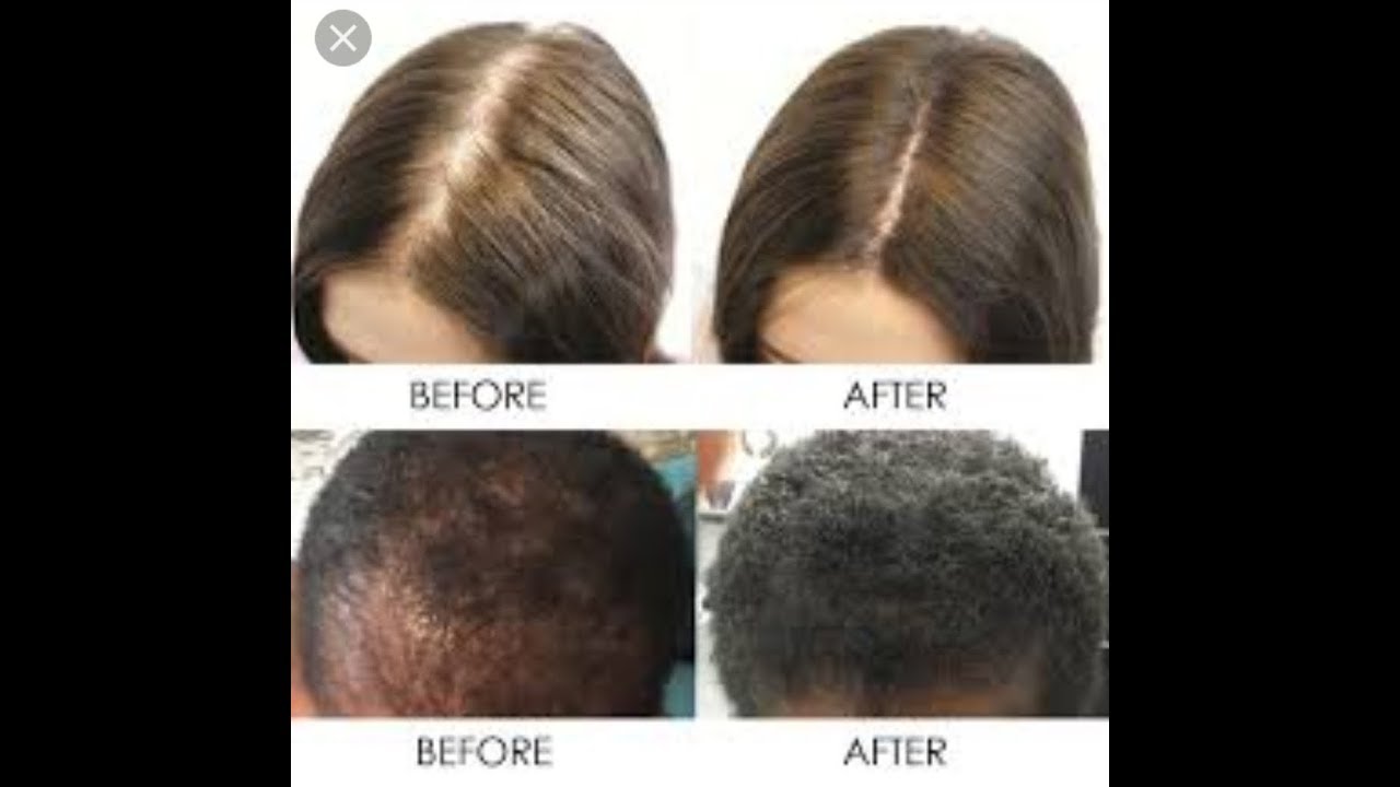 5 TIPS TO TREAT HAIRFALL AND TREAT RECEDING HAIRLINE 