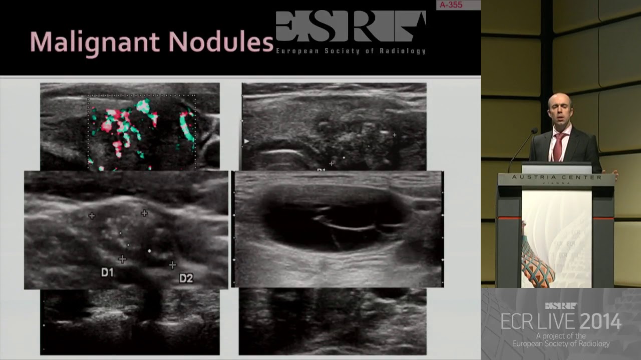 H&N SF 12   Imaging of thyroid nodules 2