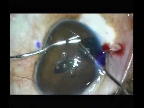 Toric IOL and complicated iridoplasty for traumatic cataract with