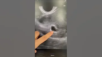 Одно плодное яйцо с эмбрионом на УЗИ