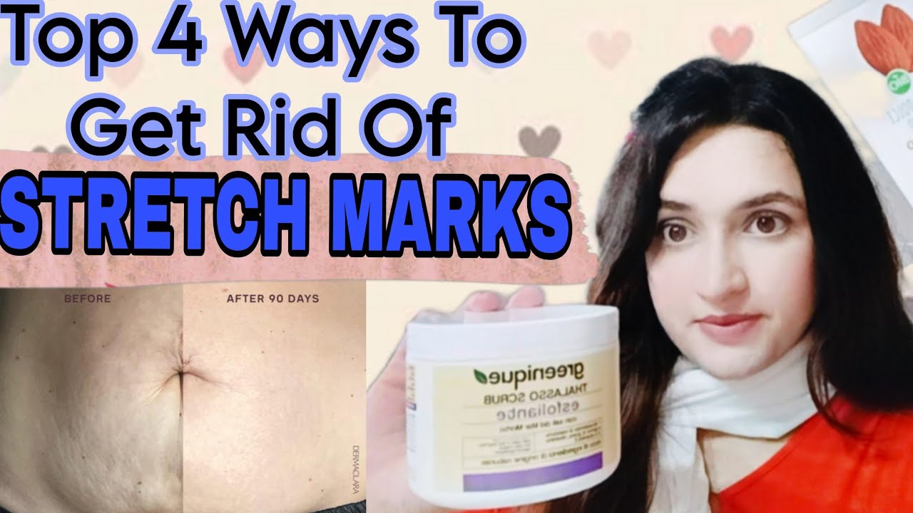 How To Get Rid Of Stretch Marks//4 Steps Bye Bye Stretch Marks 🎀//My Personal Experience✨
