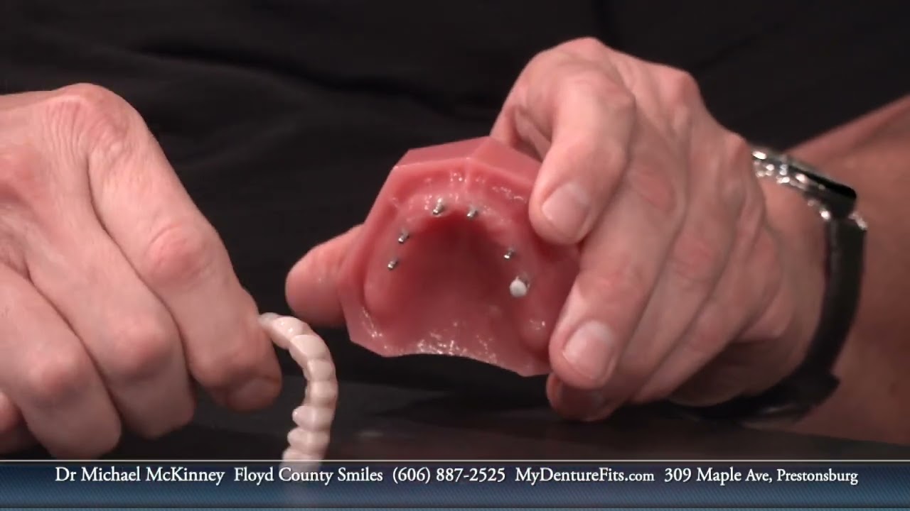 Dr McKinney - Mini Dental Implants