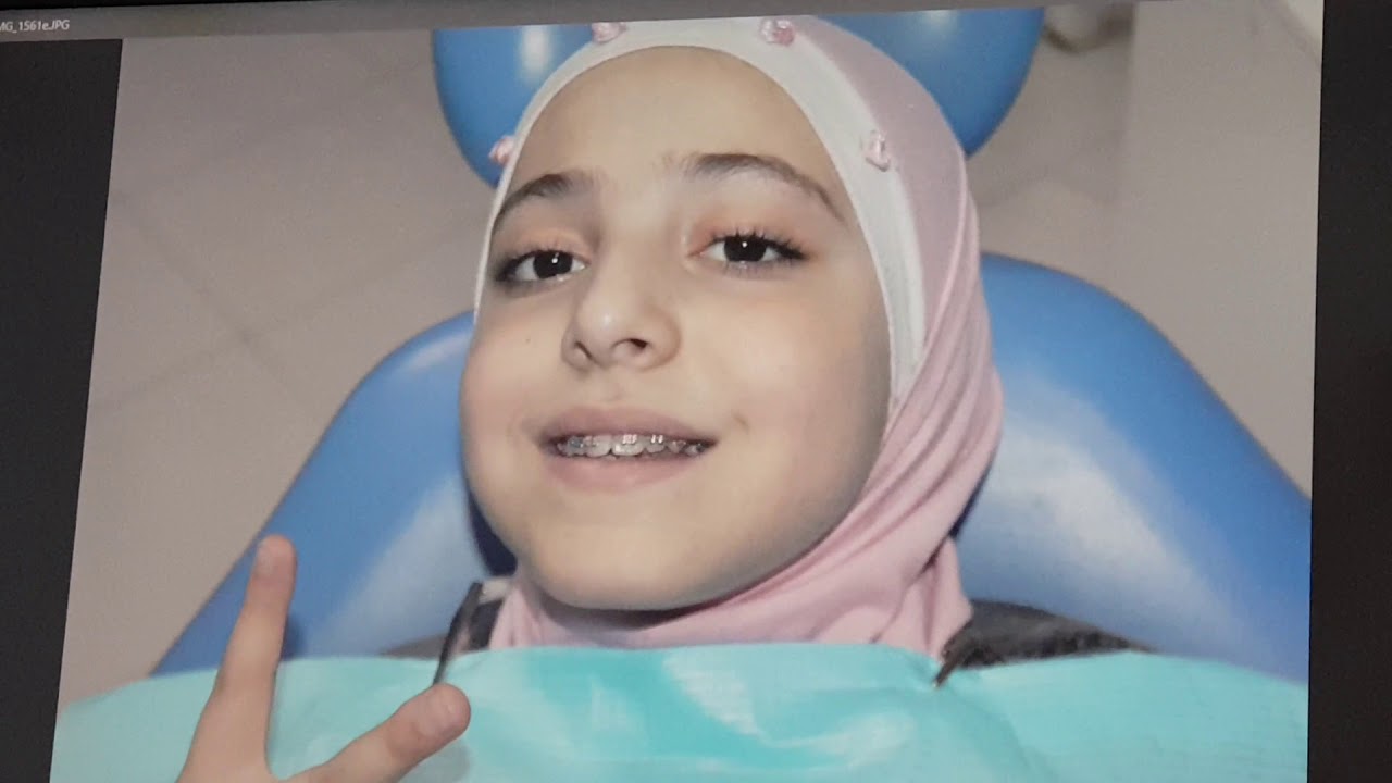 التقوم المريح للناب المطمور . Comfortable Ortho for Impacted Canine