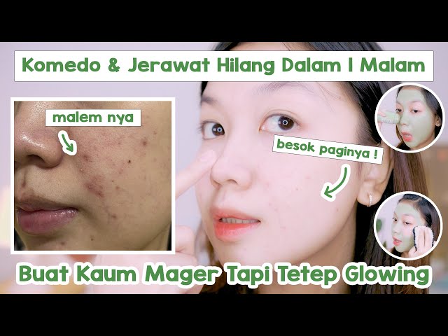 Tips Hempas Jerawat + Komedo Dalam Satu Malam || Desty Yufenti class=