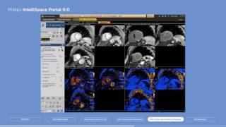 Philips IntelliSpace Portal 9.0 clinical application MR Cardiac screenshot 5