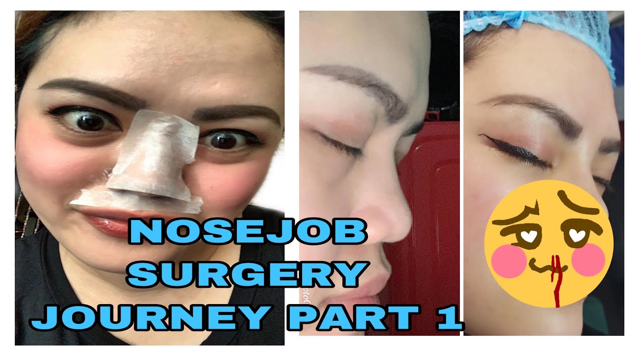 NOSE LIFT SURGERY JOURNEY IN THE PHILIPPINES PART 1 / FILIPINA BLOGGER ...