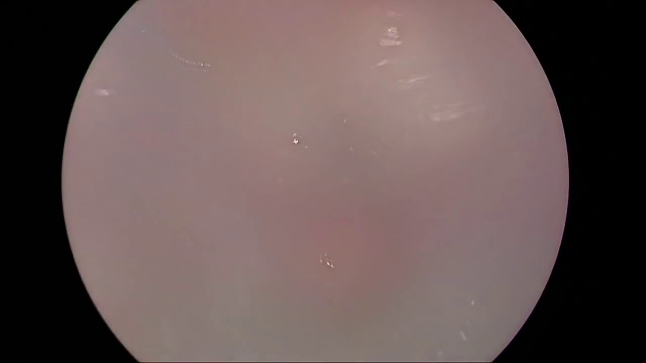 Лапароскопия - проверки проходимости маточных труб