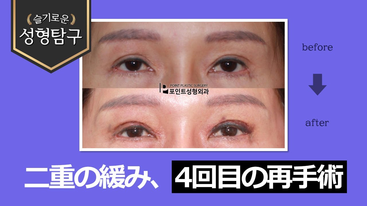 【韓国二重整形】二重の緩みで4回目の再手術