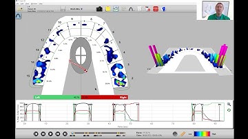 How to Analyze Maximum Intercuspation (MIP) in T-Scan Software