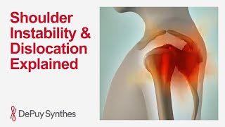 Understanding Shoulder Dislocation and Instability | DePuy Synthes