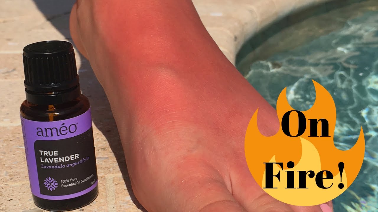 Best Essential Oils for Sunburn! 