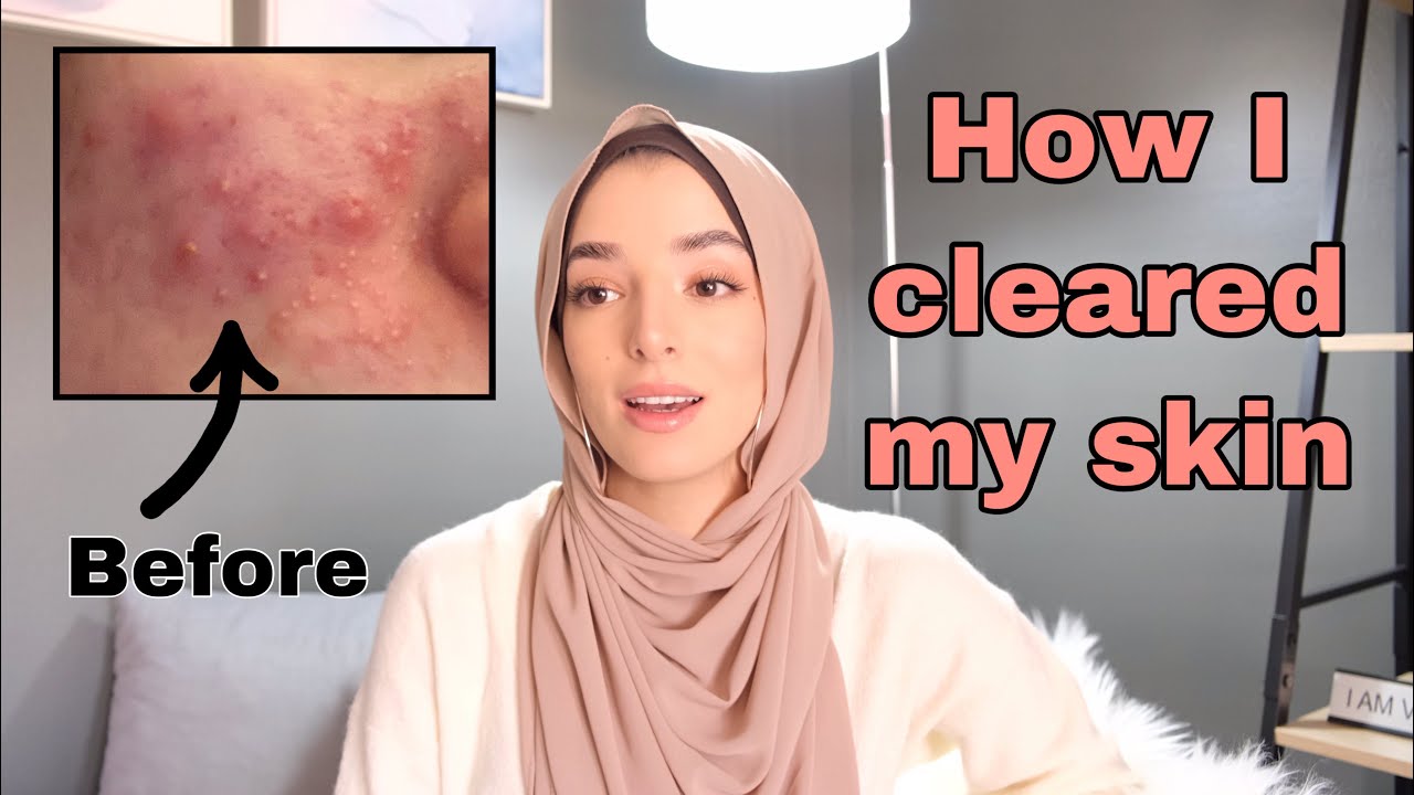 HOW I FINALLY GOT RID OF MY ACNE ... - YouTube