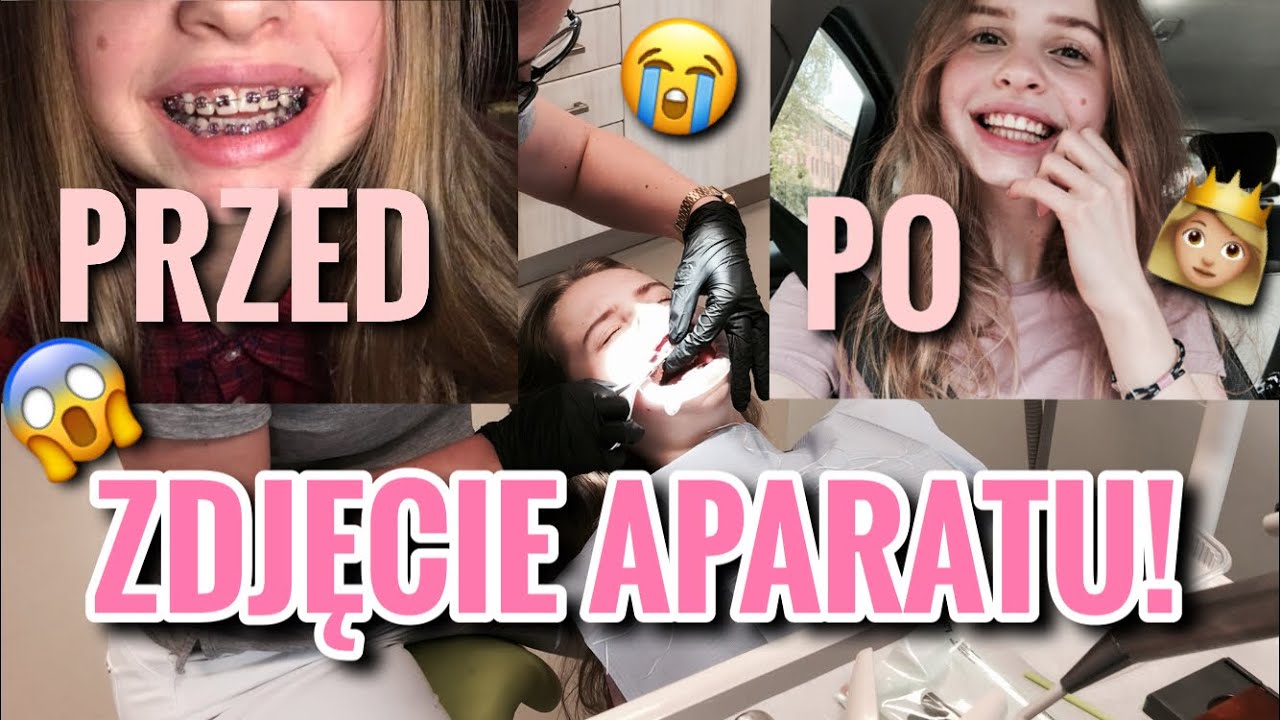 ZDJĘCIE APARATU ORTODONTYCZNEGO! 😭😱