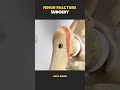 Femur Fracture Surgery. (3D Animation). #femurfractur