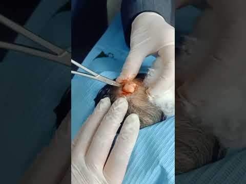 ازالة 4 اكياس دهنيه من رأس مريضه