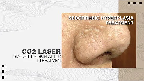 Seborrheic Hyperplasia Treatment - Bella Clinic Treatment